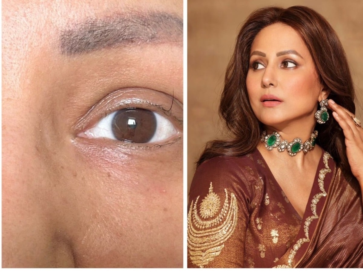 Hina Khan Shares Inspiring Photo of Her Eyelid Transformation